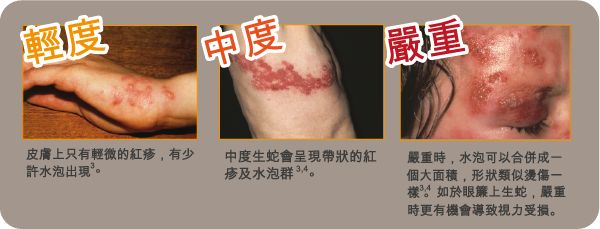 生蛇病是什么,能够预防吗?